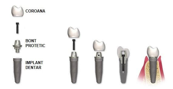 implant2